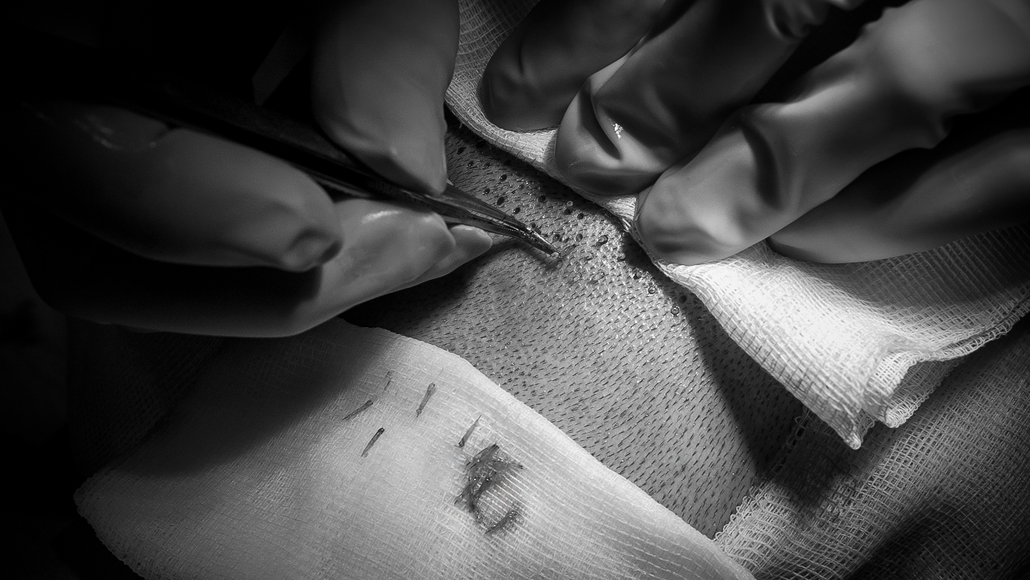 Combien de greffons sont nécessaires pour une greffe capillaire réussie ? 🤔